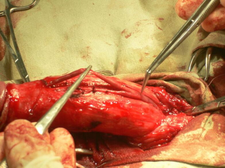 lipofilling do pênis para aumento