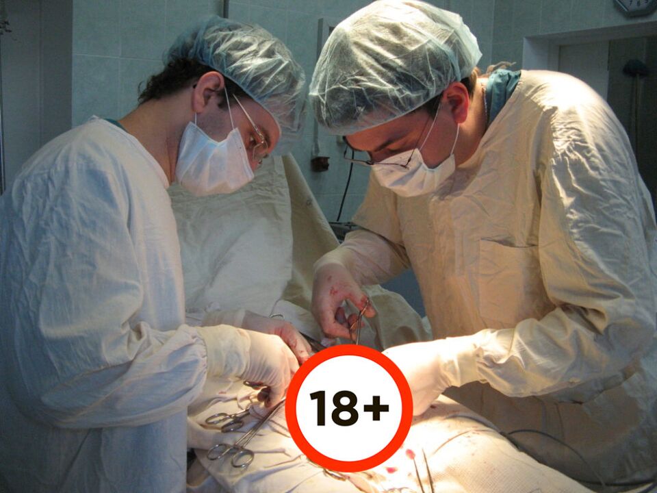 realizando cirurgia de aumento do pênis