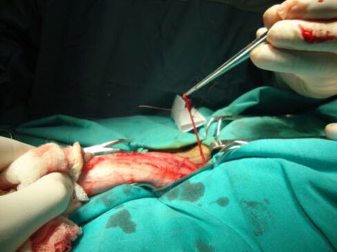 cirurgia para aumentar o pênis