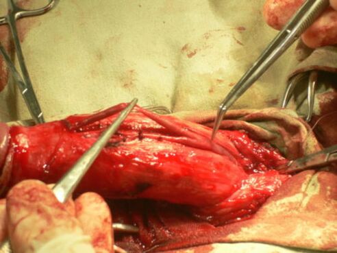 realizando cirurgia de aumento do pênis