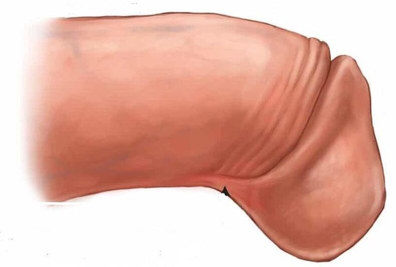 como aumentar a glande do pênis